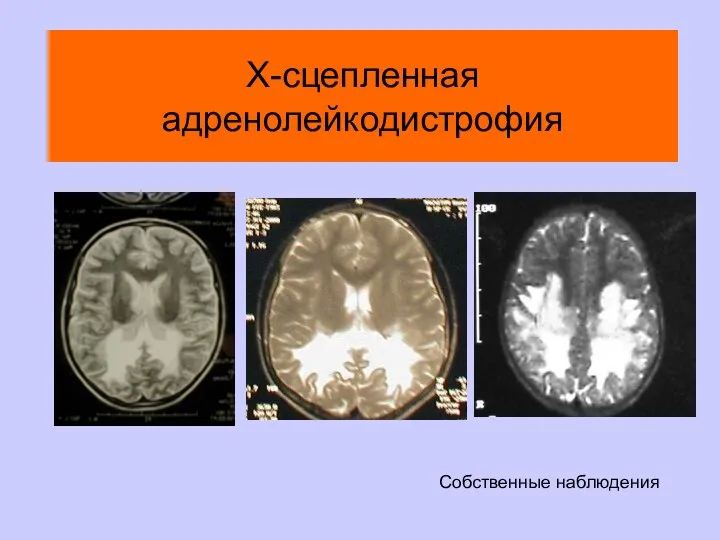 Х-сцепленная адренолейкодистрофия Собственные наблюдения