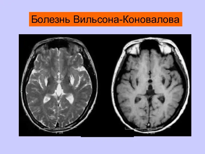 Болезнь Вильсона-Коновалова