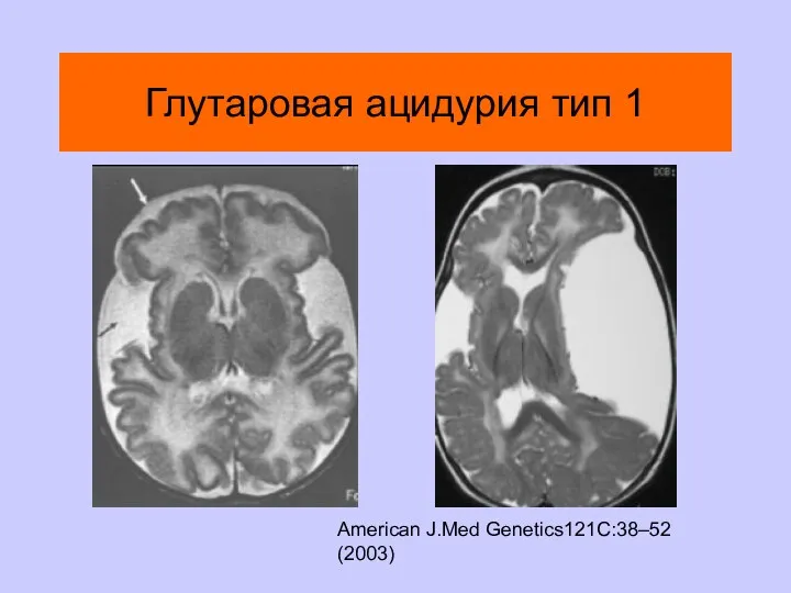 Глутаровая ацидурия тип 1 American J.Med Genetics121C:38–52 (2003)