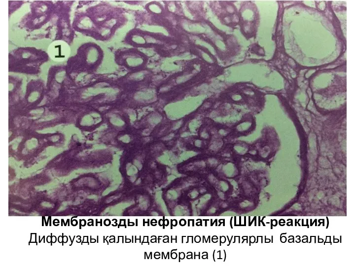 Мембранозды нефропатия (ШИК-реакция) Диффузды қалындаған гломерулярлы базальды мембрана (1)