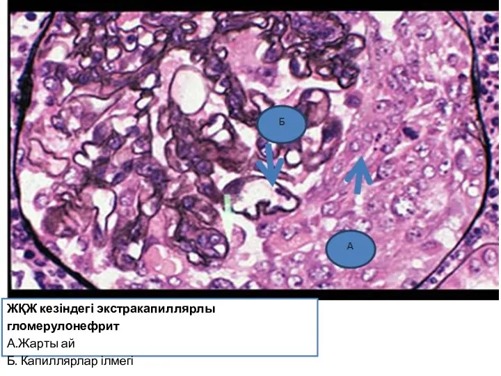 ЖҚЖ кезіндегі экстракапиллярлы гломерулонефрит А.Жарты ай Б. Капиллярлар ілмегі