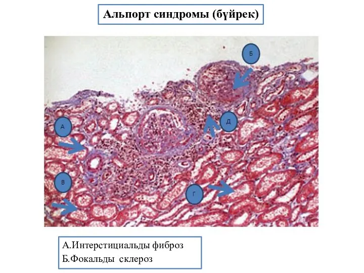 Альпорт синдромы (бүйрек) А.Интерстициальды фиброз Б.Фокальды склероз