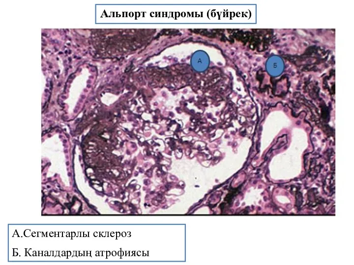 Альпорт синдромы (бүйрек) А.Сегментарлы склероз Б. Каналдардың атрофиясы