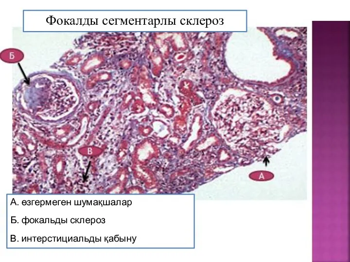 Фокалды сегментарлы склероз А. өзгермеген шумақшалар Б. фокальды склероз В. интерстициальды қабыну