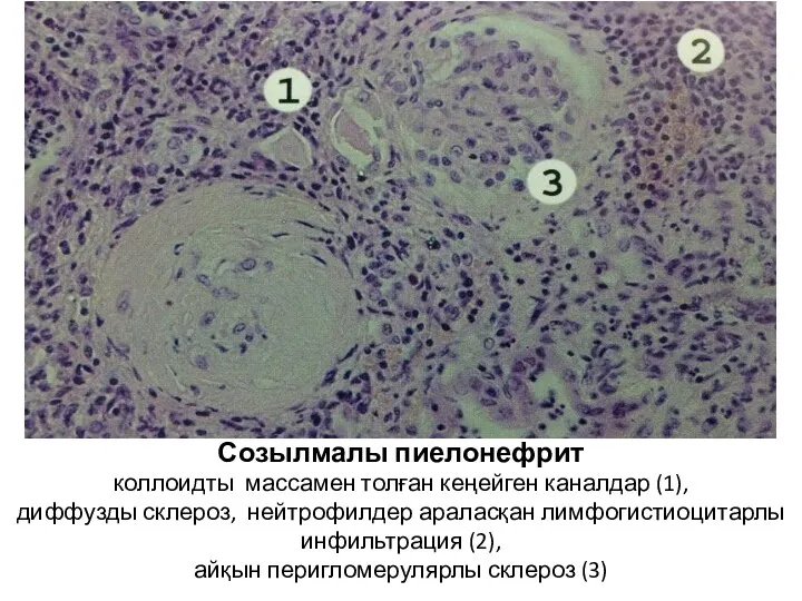 Созылмалы пиелонефрит коллоидты массамен толған кеңейген каналдар (1), диффузды склероз, нейтрофилдер араласқан лимфогистиоцитарлы