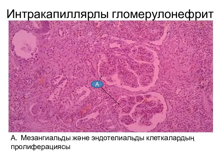Интракапиллярлы гломерулонефрит А. Мезангиальды және эндотелиальды клеткалардың пролиферациясы А