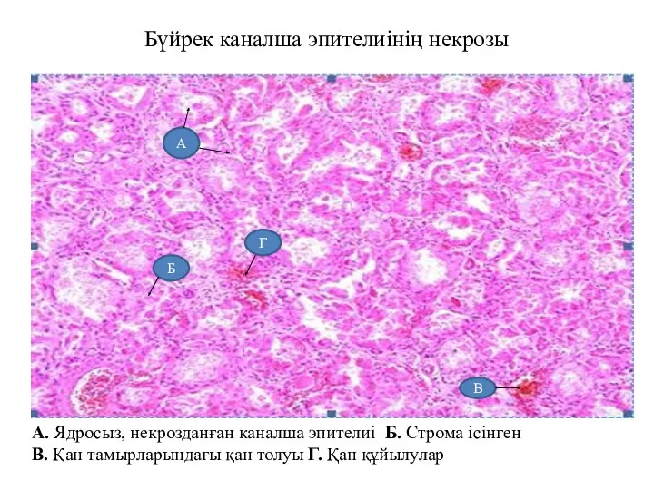 Бүйрек каналша эпителиінің некрозы А. Ядросыз, некрозданған каналша эпителиі Б. Строма ісінген В.