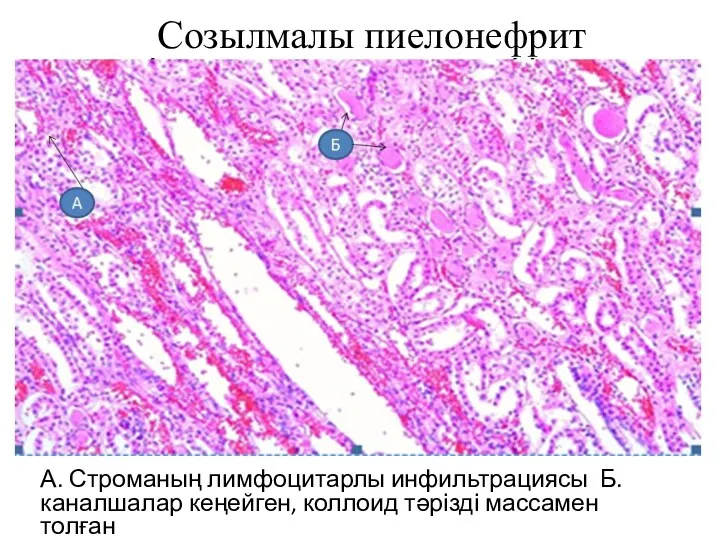 Созылмалы пиелонефрит А. Строманың лимфоцитарлы инфильтрациясы Б.каналшалар кеңейген, коллоид тәрізді массамен толған