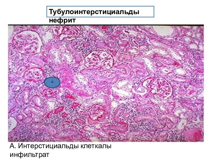 Тубулоинтерстициальды нефрит А. Интерстициальды клеткалы инфильтрат