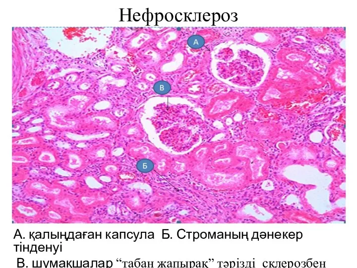 Нефросклероз А. қалыңдаған капсула Б. Строманың дәнекер тінденуі В. шумақшалар “табан жапырақ” тәрізді склерозбен
