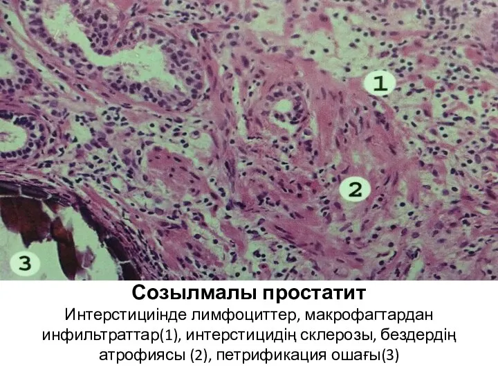 Созылмалы простатит Интерстициінде лимфоциттер, макрофагтардан инфильтраттар(1), интерстицидің склерозы, бездердің атрофиясы (2), петрификация ошағы(3)