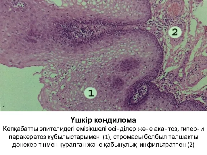 Үшкір кондилома Көпқабатты эпителидегі емізікшелі өсінділер және акантоз, гипер- и паракератоз құбылыстарымен (1),