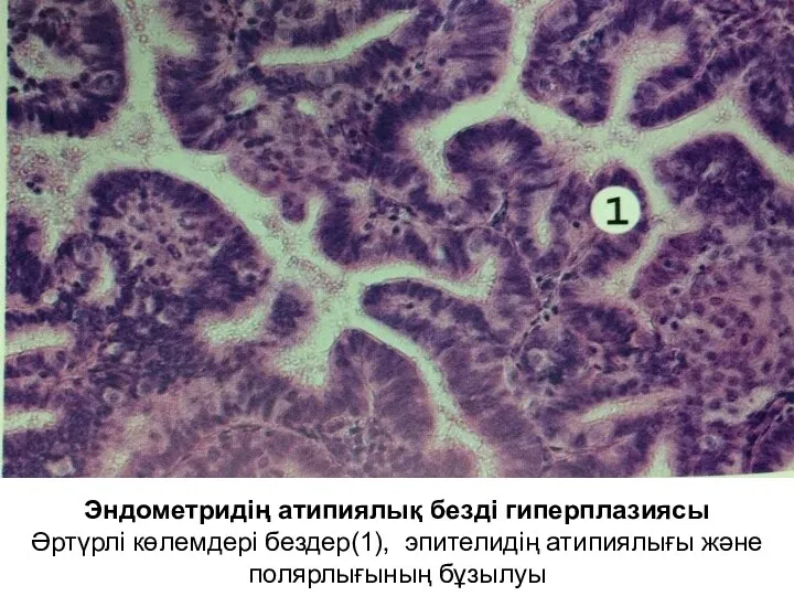 Эндометридің атипиялық безді гиперплазиясы Әртүрлі көлемдері бездер(1), эпителидің атипиялығы және полярлығының бұзылуы
