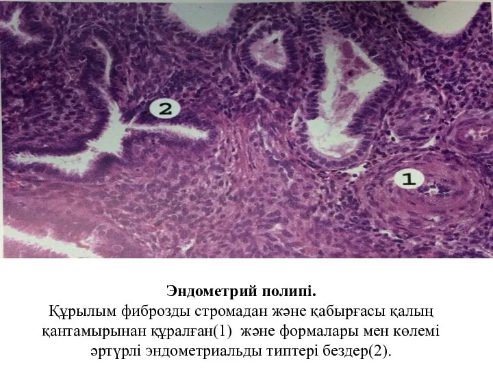 Эндометрий полипі. Құрылым фиброзды стромадан және қабырғасы қалың қантамырынан құралған(1) және формалары мен