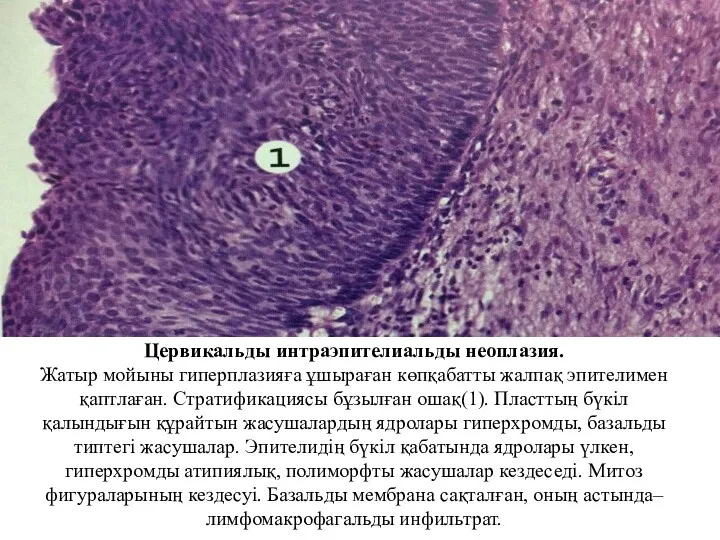 Цервикальды интраэпителиальды неоплазия. Жатыр мойыны гиперплазияға ұшыраған көпқабатты жалпақ эпителимен қаптлаған. Стратификациясы бұзылған