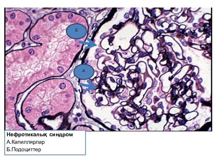 Нефротикалық синдром А.Капиллярлар Б.Подоциттер