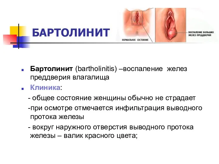 БАРТОЛИНИТ Бартолинит (bartholinitis) –воспаление желез преддверия влагалища Клиника: - общее