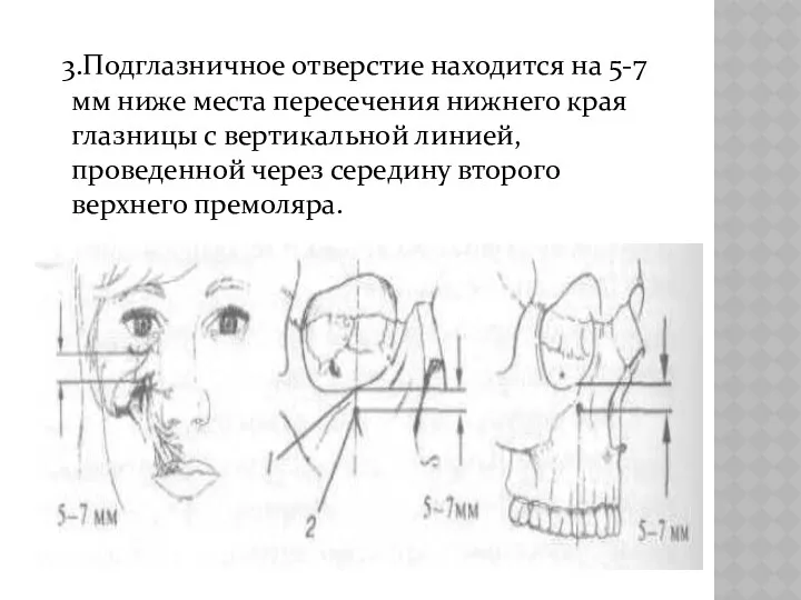 3.Подглазничное отверстие находится на 5-7 мм ниже места пересечения нижнего