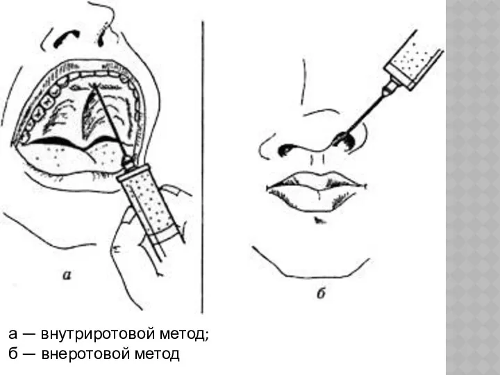 а — внутриротовой метод; б — внеротовой метод