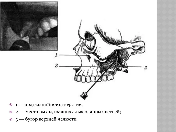 1 — подглазничное отверстие; 2 — место выхода задних альвеолярных ветвей; 3 — бугор верхней челюсти