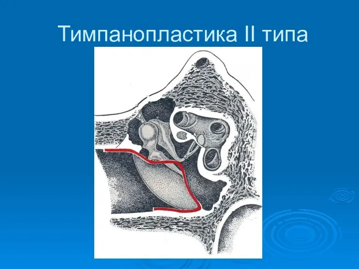 Тимпанопластика II типа