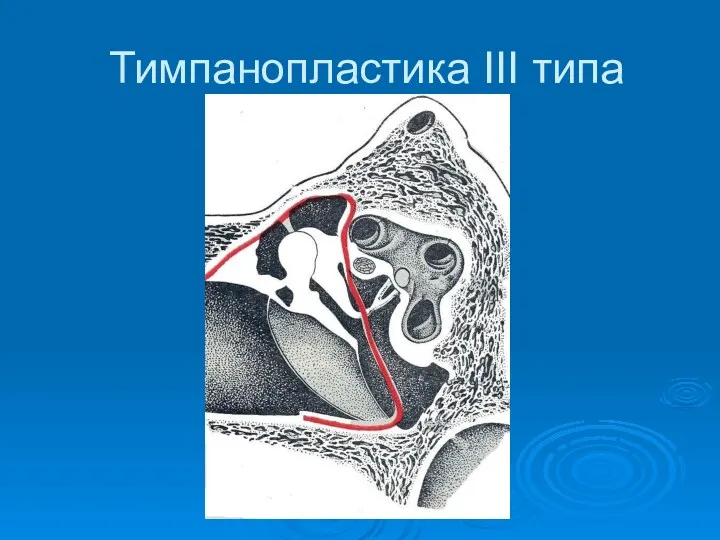 Тимпанопластика III типа