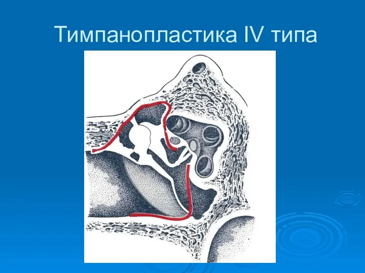 Тимпанопластика IV типа