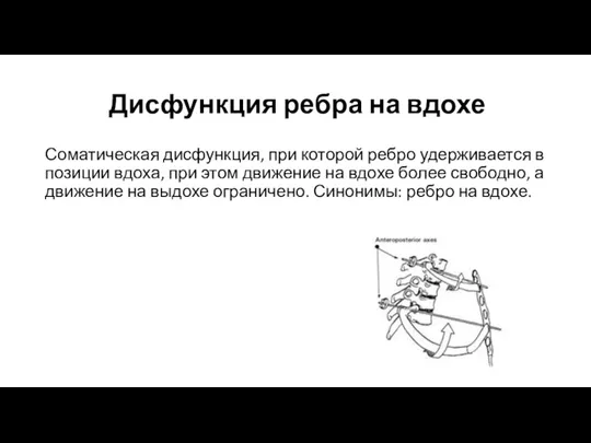 Дисфункция ребра на вдохе Соматическая дисфункция, при которой ребро удерживается