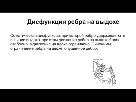 Дисфункция ребра на выдохе Соматическая дисфункция, при которой ребро удерживается