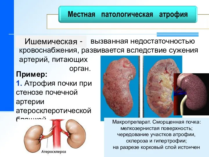 Ишемическая Пример: 1. Атрофия почки при стенозе почечной артерии атеросклеротической бляшкой - вызванная