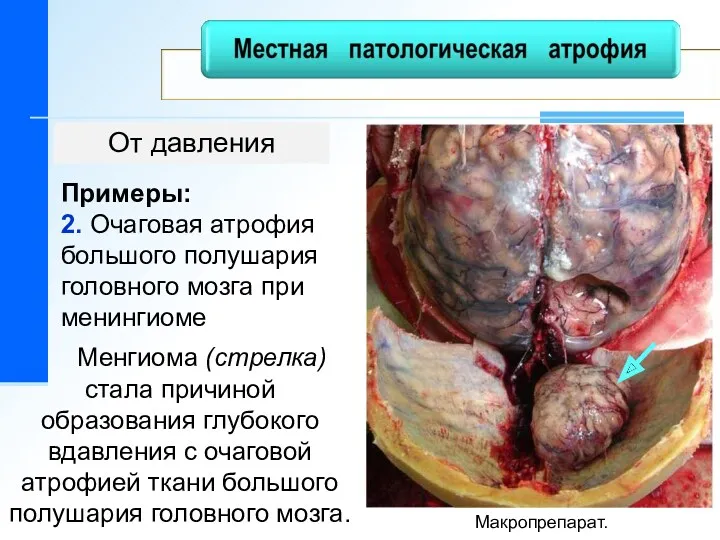 От давления Примеры: 2. Очаговая атрофия большого полушария головного мозга при менингиоме Макропрепарат.