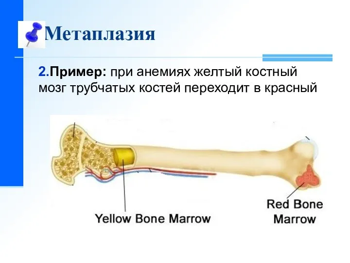Метаплазия 2.Пример: при анемиях желтый костный мозг трубчатых костей переходит в красный