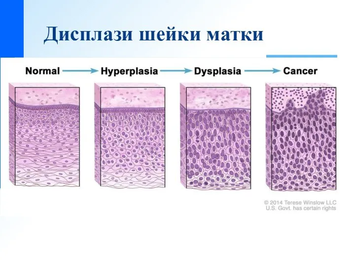 Дисплази шейки матки В соответствии со степенью пролиферации и выраженностью клеточной и тканевой