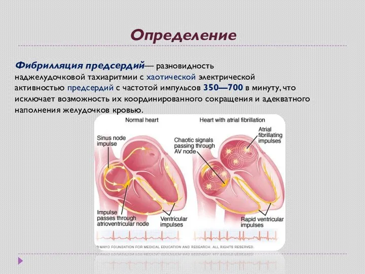 Определение Фибрилляция предсердий— разновидность наджелудочковой тахиаритмии с хаотической электрической активностью