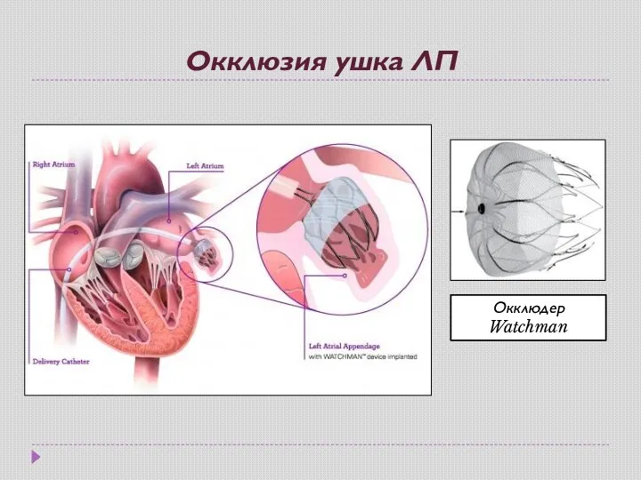 Окклюзия ушка ЛП Окклюдер Watchman
