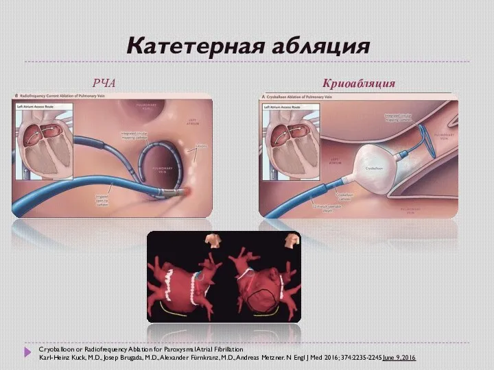 Катетерная абляция РЧА Криоабляция Cryoballoon or Radiofrequency Ablation for Paroxysmal