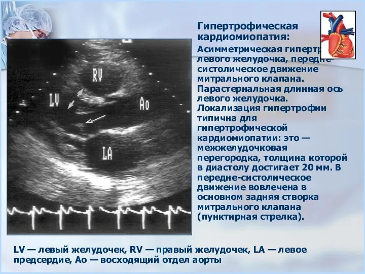 Гипертрофическая кардиомиопатия: Асимметрическая гипертрофия левого желудочка, передне-систолическое движение митрального клапана.