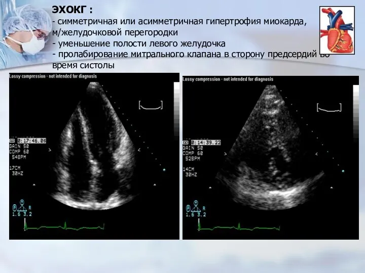 ЭХОКГ : - симметричная или асимметричная гипертрофия миокарда, м/желудочковой перегородки