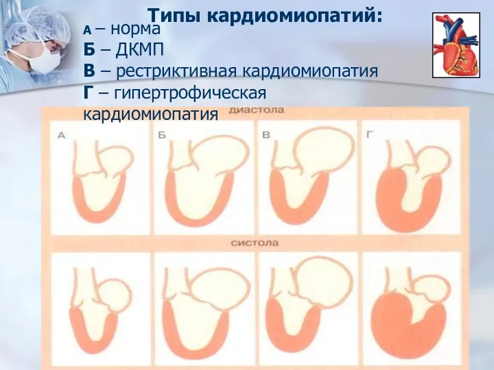 Типы кардиомиопатий: А – норма Б – ДКМП В – рестриктивная кардиомиопатия Г – гипертрофическая кардиомиопатия