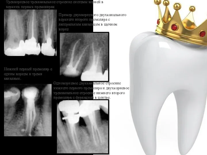 Трехкорневое трехканальное строение системы корней в верхних первых премолярах Пример