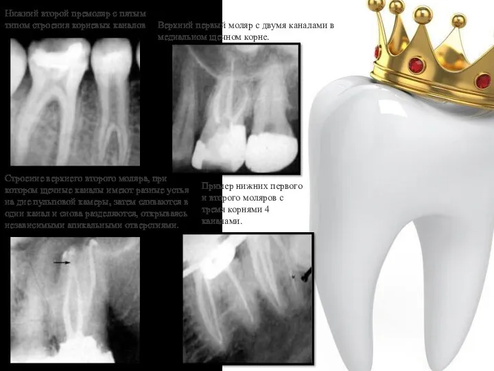 Нижний второй премоляр с пятым типом строения корневых каналов Верхний