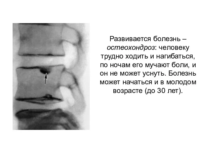 Развивается болезнь – остеохондроз: человеку трудно ходить и нагибаться, по