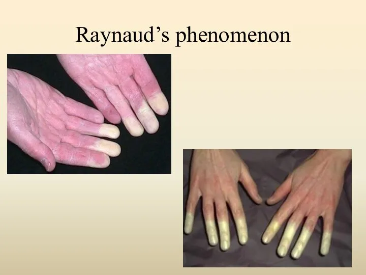 Raynaud’s phenomenon