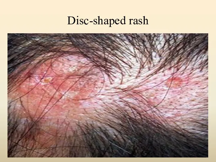 Disc-shaped rash