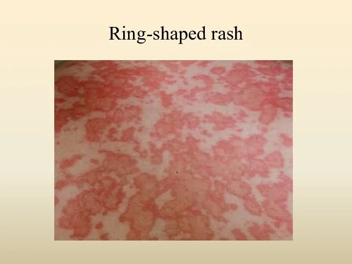 Ring-shaped rash