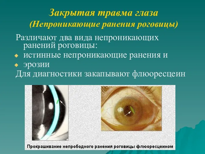 Закрытая травма глаза (Непроникающие ранения роговицы) Различают два вида непроникающих