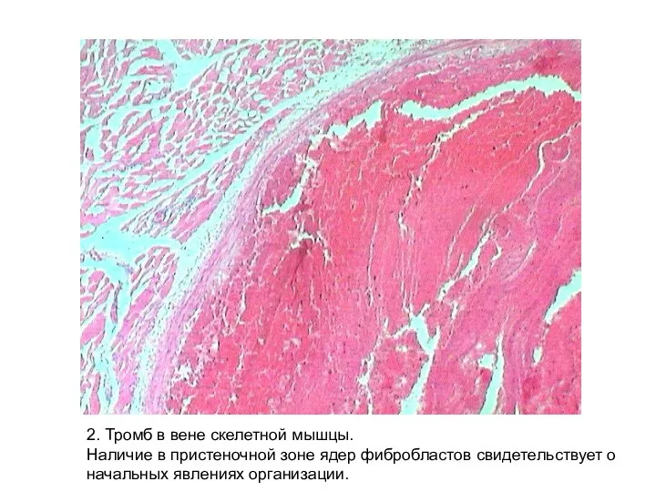 2. Тромб в вене скелетной мышцы. Наличие в пристеночной зоне