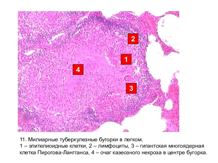 1 2 3 4 11. Милиарные туберкулезные бугорки в легком.