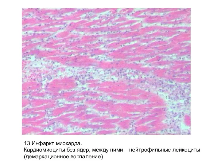 13.Инфаркт миокарда. Кардиомиоциты без ядер, между ними – нейтрофильные лейкоциты (демаркационное воспаление).