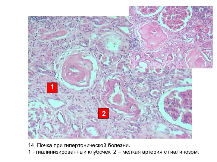 14. Почка при гипертонической болезни. 1 - гиалинизированный клубочек, 2